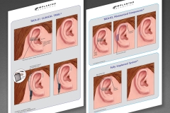 Implanted Acoustics