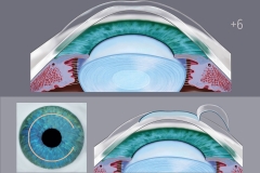 Lasik Repair Part 1