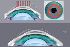 Lasik Repair Part 2