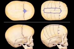 Craineostenosis