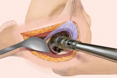 Acetabular Reaming