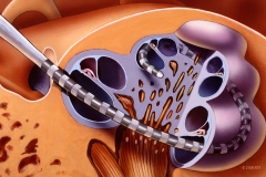 Cochlear Implant