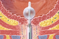 Novasys Bladder Device