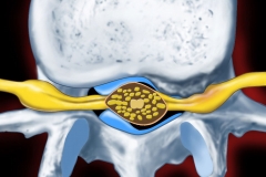Spinal Stenosis