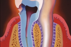 Tooth Abscess