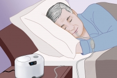 Attune Sleep Apnea System