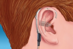 Implanted