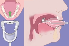 Attune Sleep Apnea System