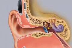 Symphonix Implantable Hearing Aid