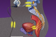 Vocare Bladder Device